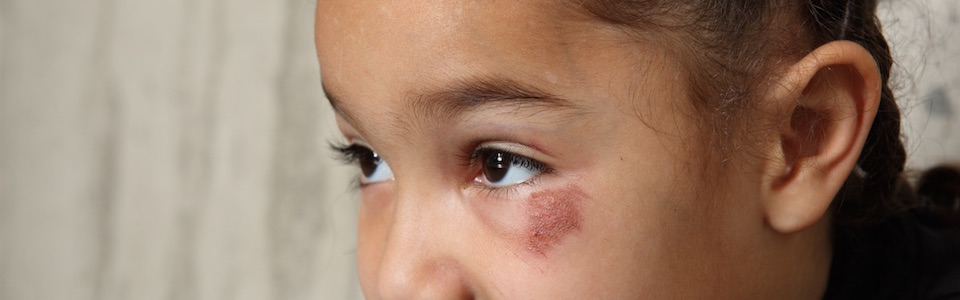 Header image of child with eye injury