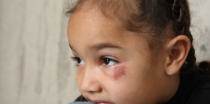 Thumbnail image of young person with eye injury